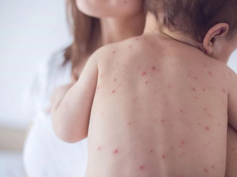 Người từng mắc thuỷ đậu có bị lây lại không?