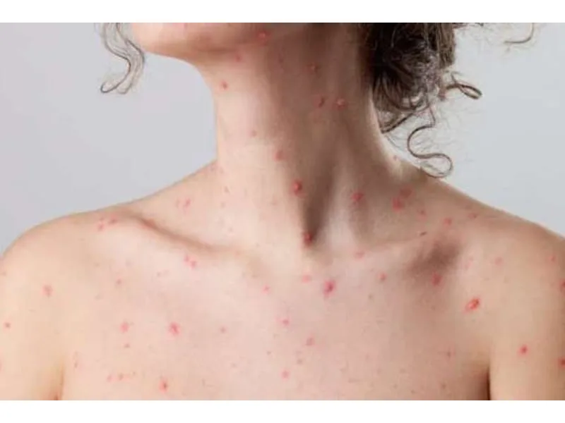 Bệnh thuỷ đậu có lây không? 7 điều cần biết để phòng tránh